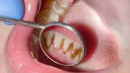 gum disease and heart health link-
High-quality dental photo illustrating the link between gum disease and heart health in adults.- মাড়ির রোগ এবং হার্টের সুস্থতার মধ্যকার গভীর সংযোগ।
